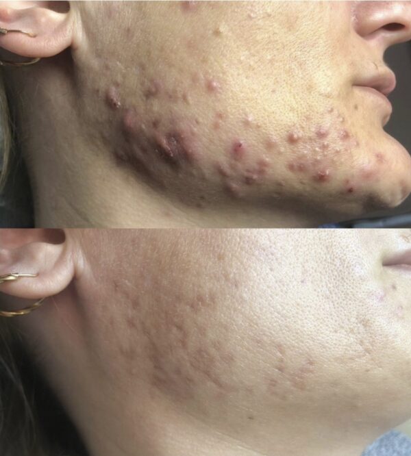 Пилинг Acne Skin - Katerina Cox