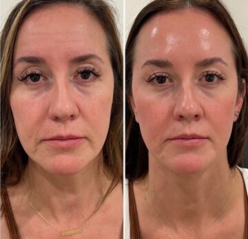 Пилинг для кожи с пигментацией - Katerina Cox