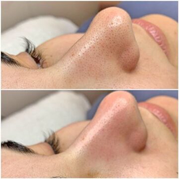 Чистка лица - Katerina Cox