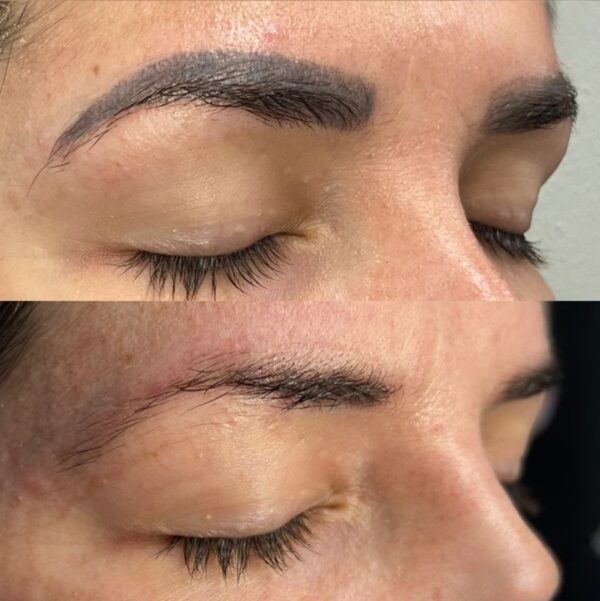 Удаление ремувером бровей - Katerina Cox