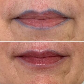 Удаление ремувером губ - Katerina Cox