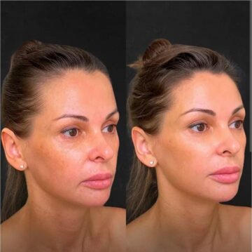 Фракционный RF-лифтинг - Katerina Cox